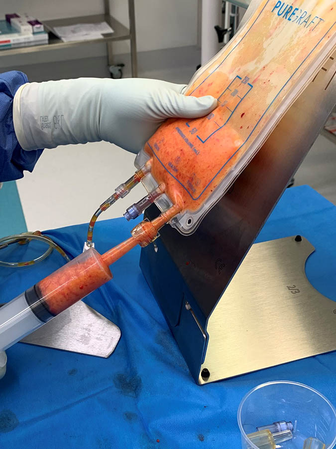 Autologous fat grafting 2