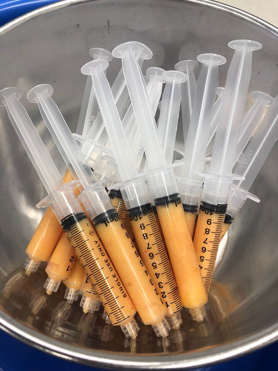 Autologous fat grafting 3