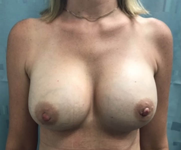 Breast Aesthetic Surgery_Breast Augmentation_1b