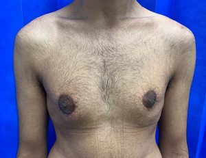 male breast reduction
