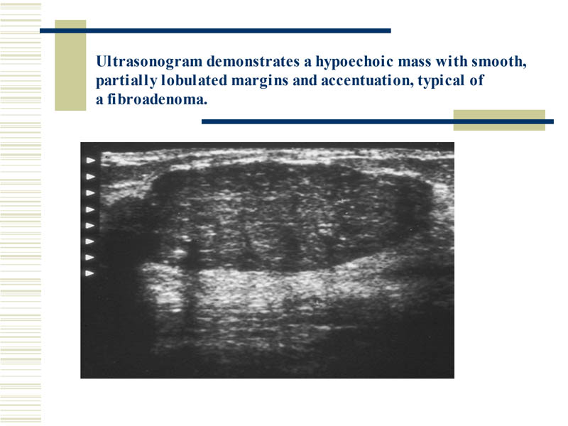 Lumps 2 breast ultrasonogram typical of fibroadenoma
