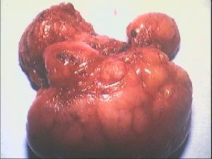 breast lumpectomy surgery melbourne