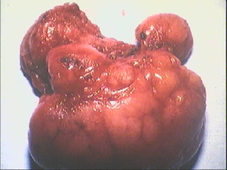 Lumps 3 breast tumour lump