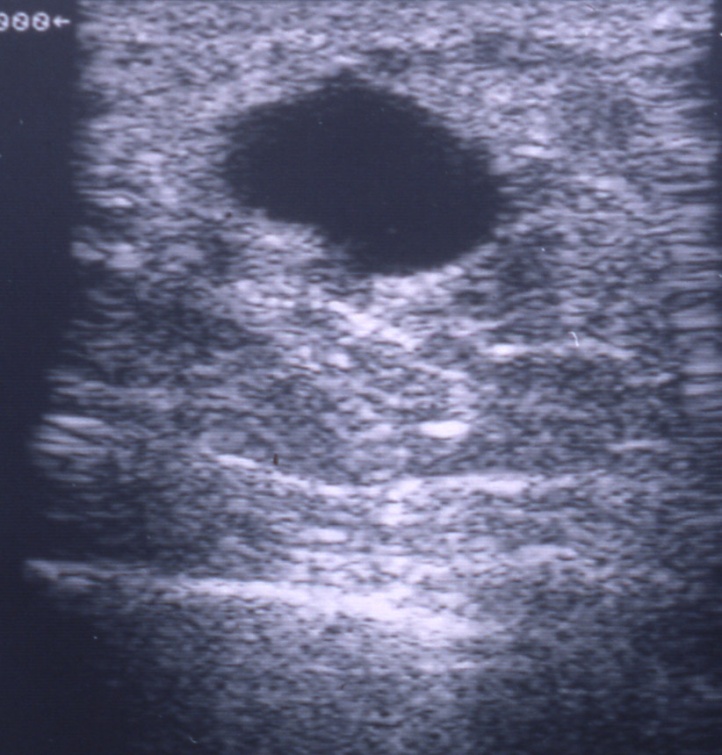 Lumps 4 breast cysts photo