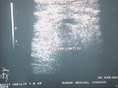 Lumps 5 post aspiration of breast cysts