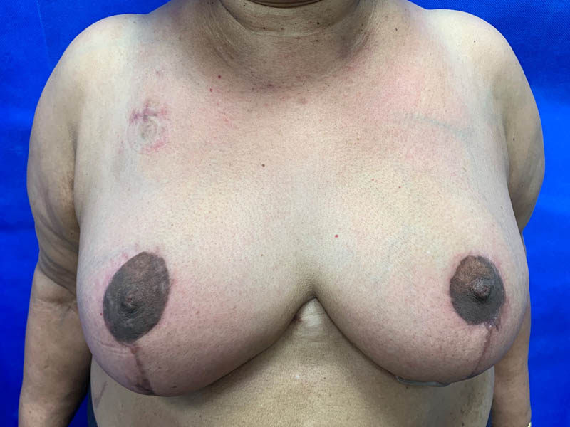 Post op ca reduction