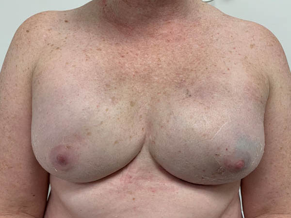 Post operative skin-sparing mastectomy with reconstruction