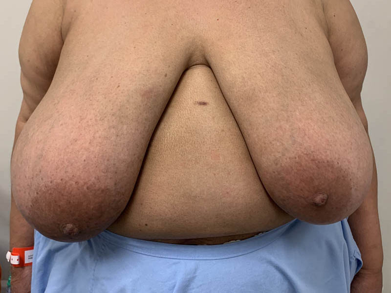 Pre op ca reduction