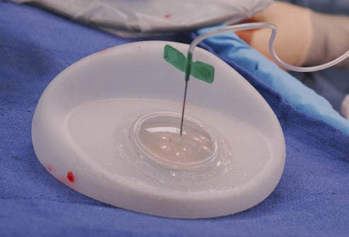Prosthetic Reconstruction 2