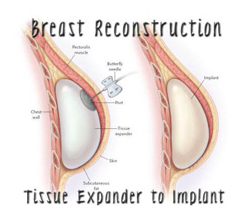 Prosthetic Reconstruction 3