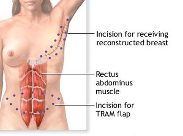 autologous reconstruction 1