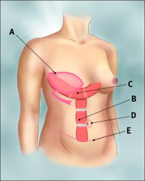 autologous reconstruction 2