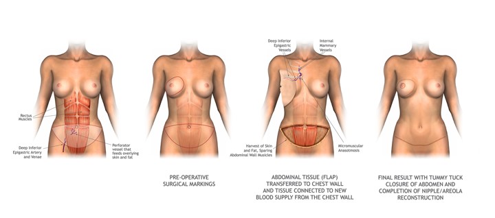 autologous reconstruction 4