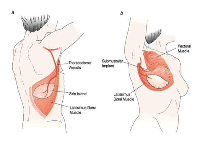 autologous reconstruction 5