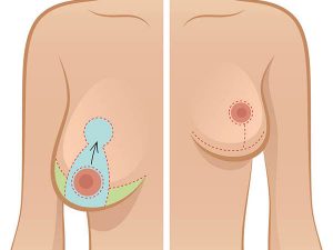 plastic surgery breast reduction melbourne