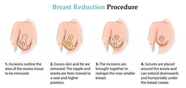 breast-reduction-procedure 2