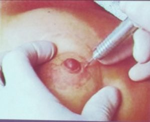 best nipple reconstruction surgery melbourne