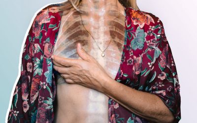 What Is Metastatic Breast Cancer? Doctors Explain the Advanced Form of the Disease